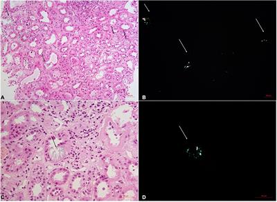 Acute oxalate nephropathy: A potential cause of acute kidney injury in diabetes mellitus—A case series from a single center